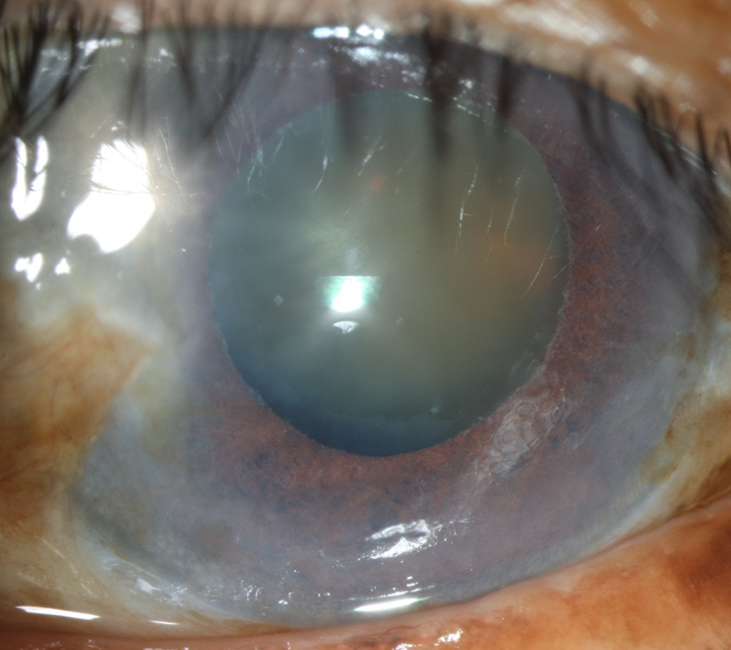 Oeil attend de cataracte