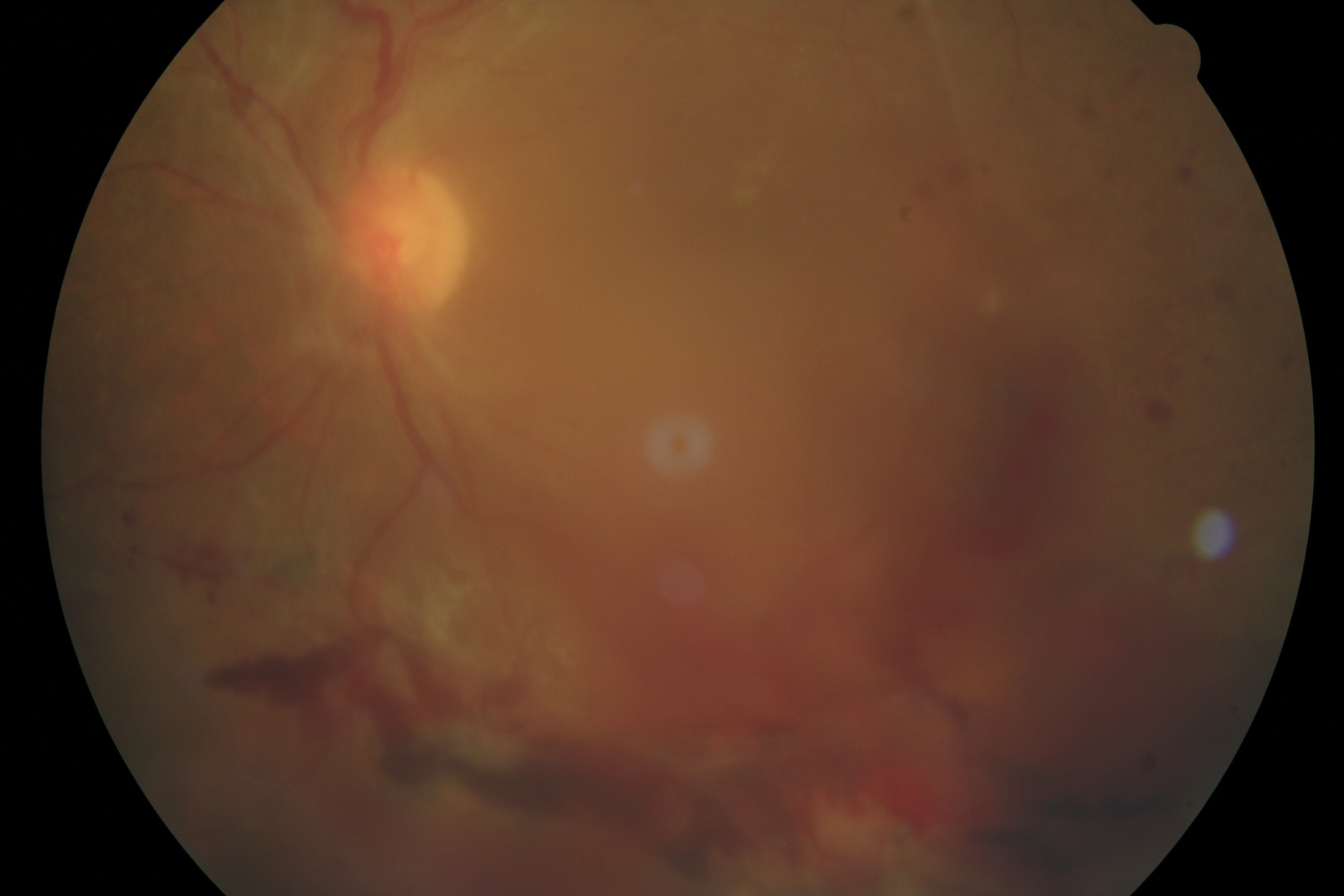 retinopathie pré proliférante 